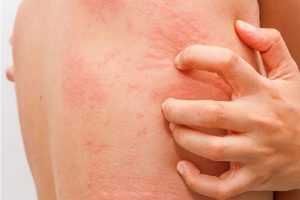 Các Dạng Dị Ứng Nước Hồ Bơi, Biểu Hiện Ngoài Da